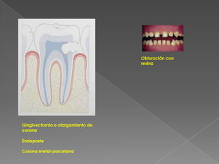   El diagnóstico y el pronóstico permiten establecer el mejor plan terapéutico para el paciente y sólo si se cumple este esquema de base se podrá llevar a cabo una restauración ideal, funcional y estética