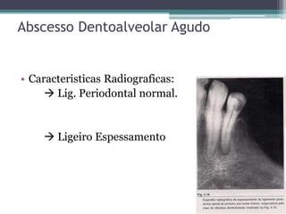 Abscesso Dentoalveolar Agudo
• Caracteristicas Radiograficas:
 Lig. Periodontal normal.
 Ligeiro Espessamento
 