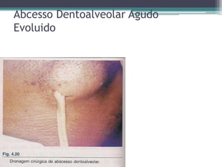 Abcesso Dentoalveolar Agudo
Evoluido
 