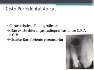 Cisto Periodontal Apical
• Caracteristicas Radiograficas:
Não existe diferenças radiograficas entre C.P.A
e G.P
Osteite Rarefaciente circunscrita
 