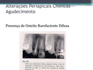 Alteraçoes Periapicais Cronicas –
Agudecimento
Presença de Osteite Rarefaciente Difusa
 