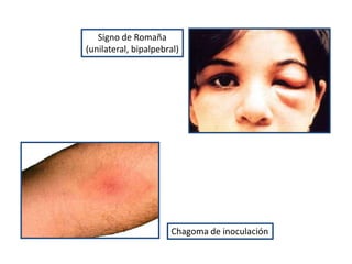 Chagoma de inoculación
Signo de Romaña
(unilateral, bipalpebral)
 