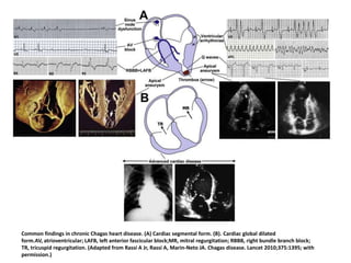 Common findings in chronic Chagas heart disease. (A) Cardiac segmental form. (B). Cardiac global dilated
form.AV, atrioventricular; LAFB, left anterior fascicular block;MR, mitral regurgitation; RBBB, right bundle branch block;
TR, tricuspid regurgitation. (Adapted from Rassi A Jr, Rassi A, Marin-Neto JA. Chagas disease. Lancet 2010;375:1395; with
permission.)
 