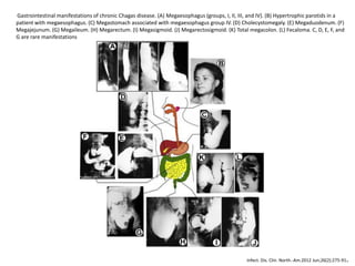 Gastrointestinal manifestations of chronic Chagas disease. (A) Megaesophagus (groups, I, II, III, and IV). (B) Hypertrophic parotids in a
patient with megaesophagus. (C) Megastomach associated with megaesophagus group IV. (D) Cholecystomegaly. (E) Megaduodenum. (F)
Megajejunum. (G) Megaileum. (H) Megarectum. (I) Megasigmoid. (J) Megarectosigmoid. (K) Total megacolon. (L) Fecaloma. C, D, E, F, and
G are rare manifestations
Infect. Dis. Clin. North.-Am.2012 Jun;26(2):275-91.
 