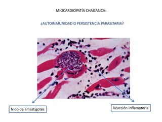 Nido de amastigotes Reacción inflamatoria
MIOCARDIOPATÍA CHAGÁSICA:
¿AUTOINMUNIDAD O PERSISTENCIA PARASITARIA?
 