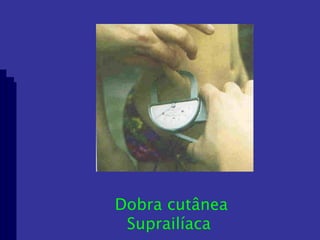 Dobra cutânea Suprailíaca  