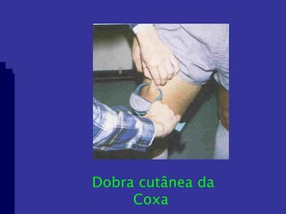Dobra cutânea da Coxa  