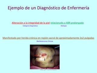 Ejemplo de un Diagnóstico de Enfermería Alteración a la integridad de la piel   relacionado a ABR prolongado Manifestado por herida crónica en región sacral de aproximadamente 2x2 pulgadas Etiología  Categoría Diagnóstica Manifestaciones Clínicas  Copyright: Sandra Zapata  
