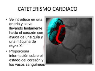 CATETERISMO CARDIACOSe introduce en una arteria y se va llevando lentamente hacia el corazón con ayuda de una guía y una máquina de rayos X.Proporciona información sobre el estado del corazón y los vasos sanguíneos