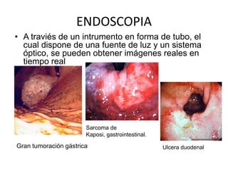 ENDOSCOPIAA traviés de un intrumento en forma de tubo, el cual dispone de una fuente de luz y un sistema óptico, se pueden obtener imágenes reales en tiempo realSarcoma de Kaposi, gastrointestinal.Gran tumoración gástricaUlcera duodenal