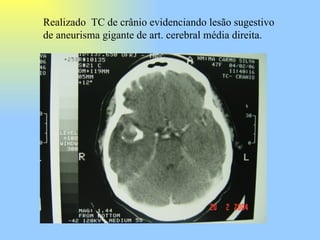 Realizado  TC de crânio evidenciando lesão sugestivo de aneurisma gigante de art. cerebral média direita. 