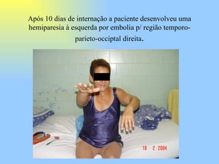 Após 10 dias de internação a paciente desenvolveu uma hemiparesia à esquerda por embolia p/ região temporo-parieto-occiptal direita . 