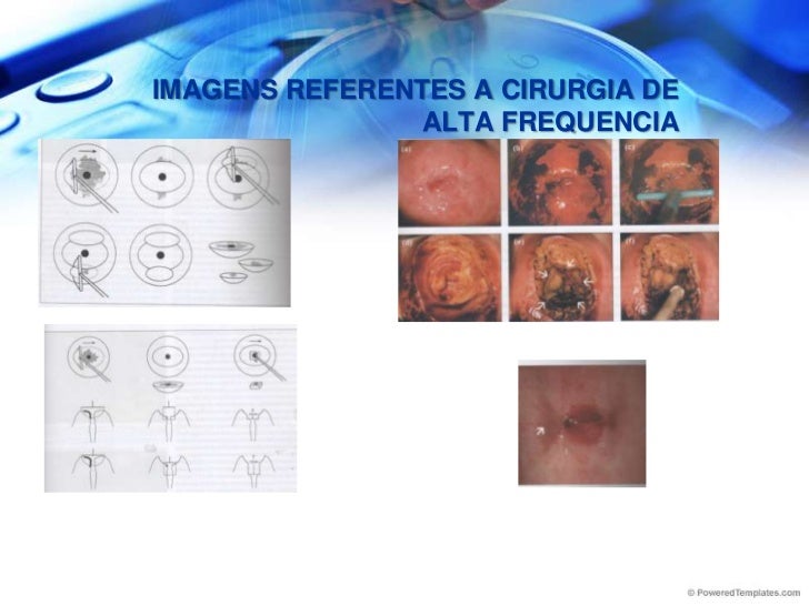 DiagnóStico E Tratamento Das DoençAs Do Colo Uterino