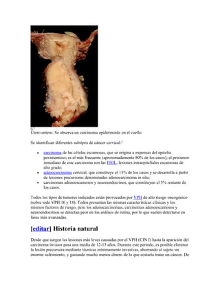 Útero entero: Se observa un carcinoma epidermoide en el cuello

Se identifican diferentes subtipos de cáncer cervical:2

   •   carcinoma de las células escamosas, que se origina a expensas del epitelio
       pavimentoso; es el más frecuente (aproximadamente 80% de los casos); el precursor
       inmediato de este carcinoma son las HSIL, lesiones intraepiteliales escamosas de
       alto grado;
   •   adenocarcinoma cervical, que constituye el 15% de los casos y se desarrolla a partir
       de lesiones precursoras denominadas adenocarcinoma in situ;
   •   carcinomas adenoescamosos y neuroendocrinos, que constituyen el 5% restante de
       los casos.

Todos los tipos de tumores indicados están provocados por VPH de alto riesgo oncogénico
(sobre todo VPH 16 y 18). Todos presentan las mismas características clínicas y los
mismos factores de riesgo, pero los adenocarcinomas, carcinomas adenoescamosos y
neuroendocrinos se detectan peor en los análisis de rutina, por lo que suelen detectarse en
fases más avanzadas.

[editar] Historia natural
Desde que surgen las lesiones más leves causadas por el VPH (CIN I) hasta la aparición del
carcinoma invasor pasa una media de 12-13 años. Durante este periodo, es posible eliminar
la lesión precursora mediante técnicas mínimamente invasivas, ahorrando al sujeto un
enorme sufrimiento, y gastando mucho menos dinero de lo que costaría tratar un cáncer. De
 