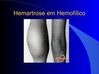 Hemartrose em HemofílicoHemartrose em Hemofílico
 