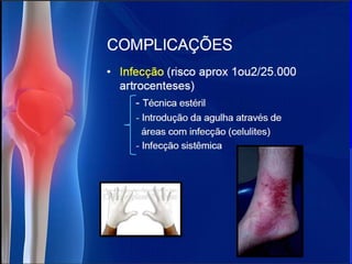 Diagnósticos diferenciais das monoartrites.