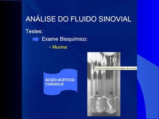 Diagnósticos diferenciais das monoartrites.