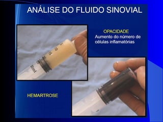 Diagnósticos diferenciais das monoartrites.