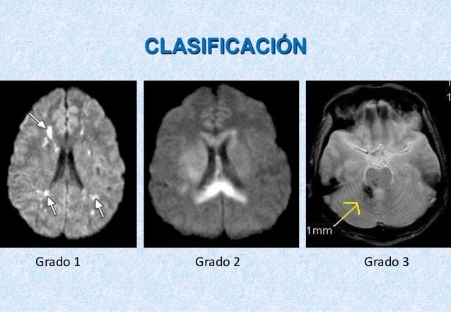 Daño axonal difuso secundario a traumatismo craneoencefálico