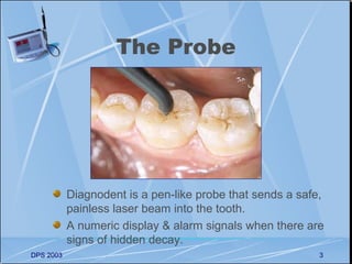 The Probe




           Diagnodent is a pen-like probe that sends a safe,
           painless laser beam into the tooth.
           A numeric display & alarm signals when there are
           signs of hidden decay.
DPS 2003                                                   3
 