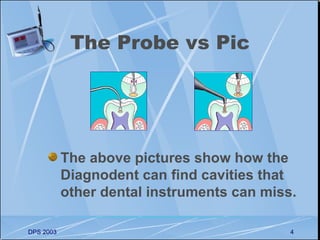 The Probe vs Pic




           The above pictures show how the
           Diagnodent can find cavities that
           other dental instruments can miss.

DPS 2003                                    4
 