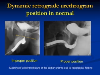 Normal Retrograde Urethrogram Transverse Diagosis of urethral stricture | PPTX