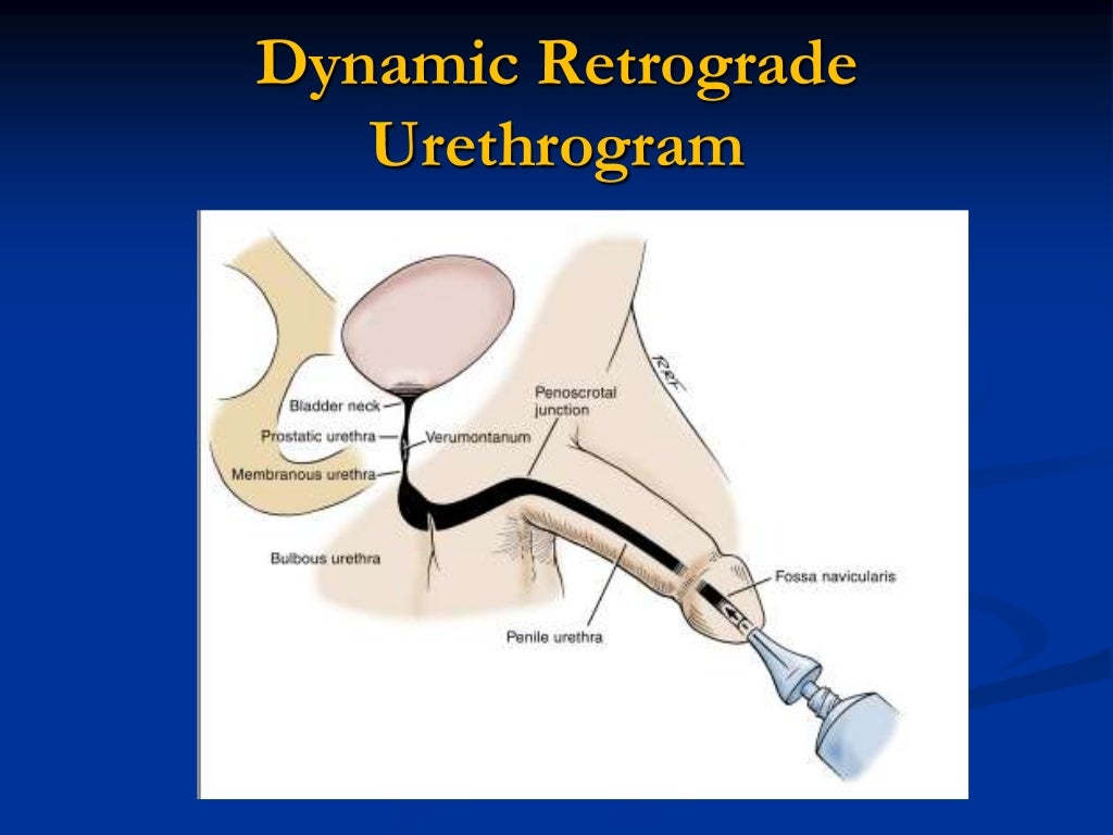 Diagosis of urethral stricture
