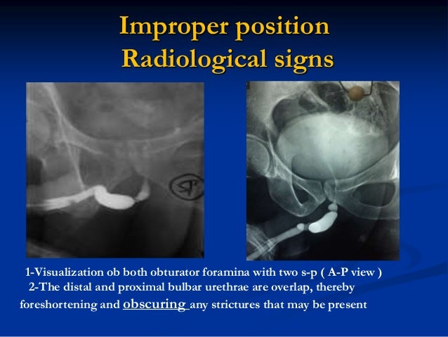 Diagosis of urethral stricture
