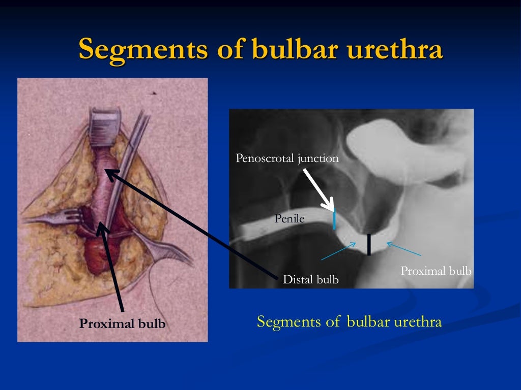 Diagosis of urethral stricture