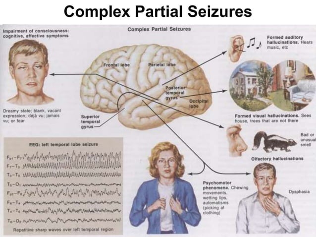 Diagrams-Eeg-Epilepsy.ppt | Brain and Nervous System Disorders ...