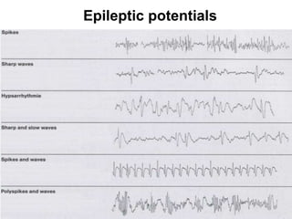 Epileptic potentials
 