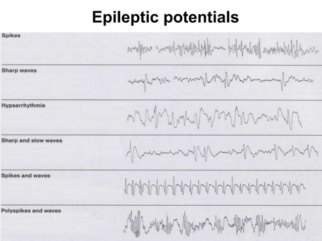 Welche Epilepsie Arten Gibt Es www.slideshare.net