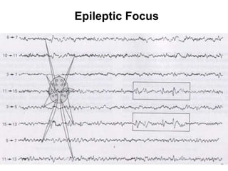 Epileptic Focus
 