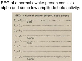 EEG of a normal awake person consists
alpha and some low amplitude beta activity:
 