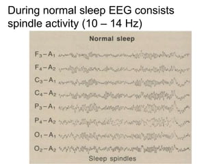 During normal sleep EEG consists
spindle activity (10 – 14 Hz)
 