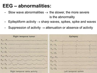 EEG – abnormalities:
- Slow wave abnormalities  the slower, the more severe
is the abnormality
- Epileptiform activity  sharp waves, spikes, spike and waves
- Suppression of activity  attenuation or absence of activity
 