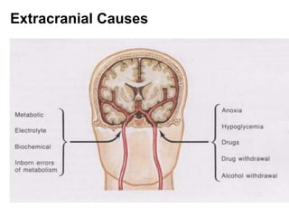 Extracranial Causes
 