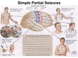 Simple Partial Seizures
 