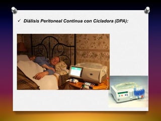  Diálisis Peritoneal Continua con Cicladora (DPA):
 
