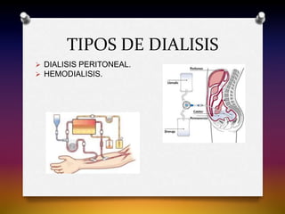 TIPOS DE DIALISIS
 DIALISIS PERITONEAL.
 HEMODIALISIS.
 