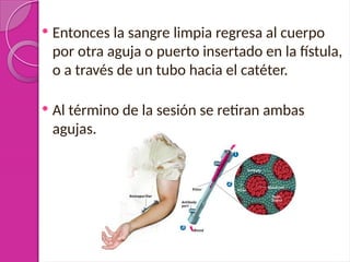  Entonces la sangre limpia regresa al cuerpo
por otra aguja o puerto insertado en la fístula,
o a través de un tubo hacia el catéter.
 Al término de la sesión se retiran ambas
agujas.
 