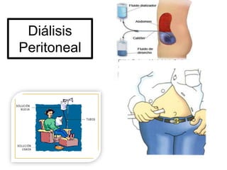 Diálisis
Peritoneal
 