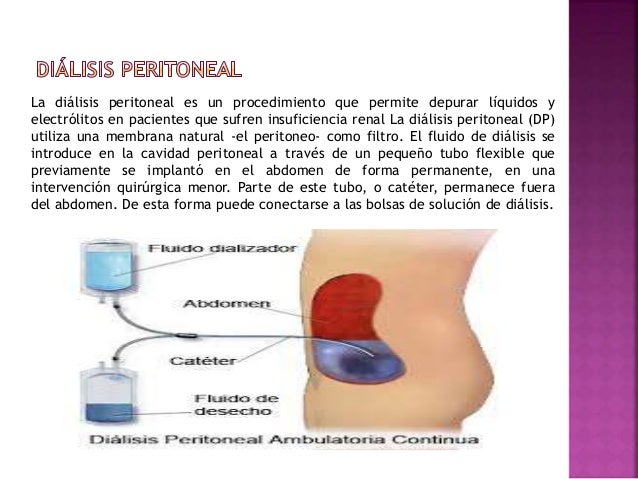 Dialisis peritoneal Oldaly Sánchez