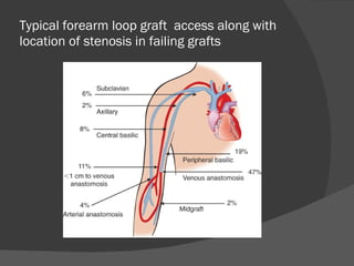CME: Dialysis & Transplantation | PPT