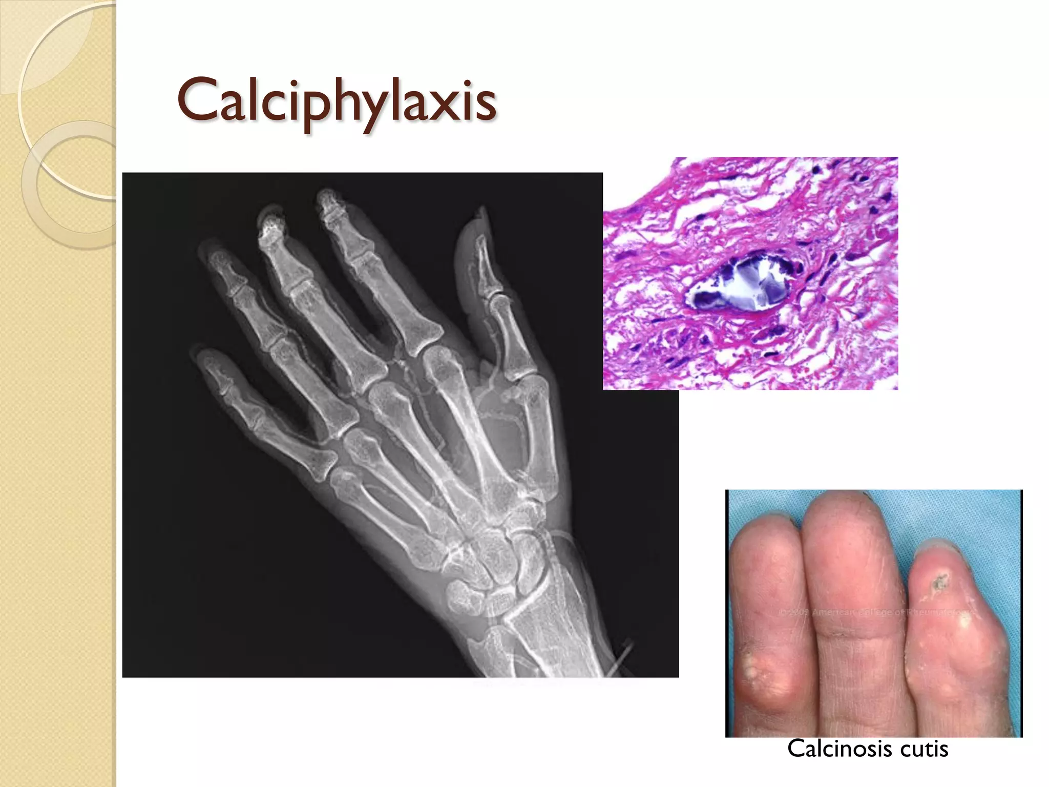 Calciphylaxis
Calcinosis cutis
 