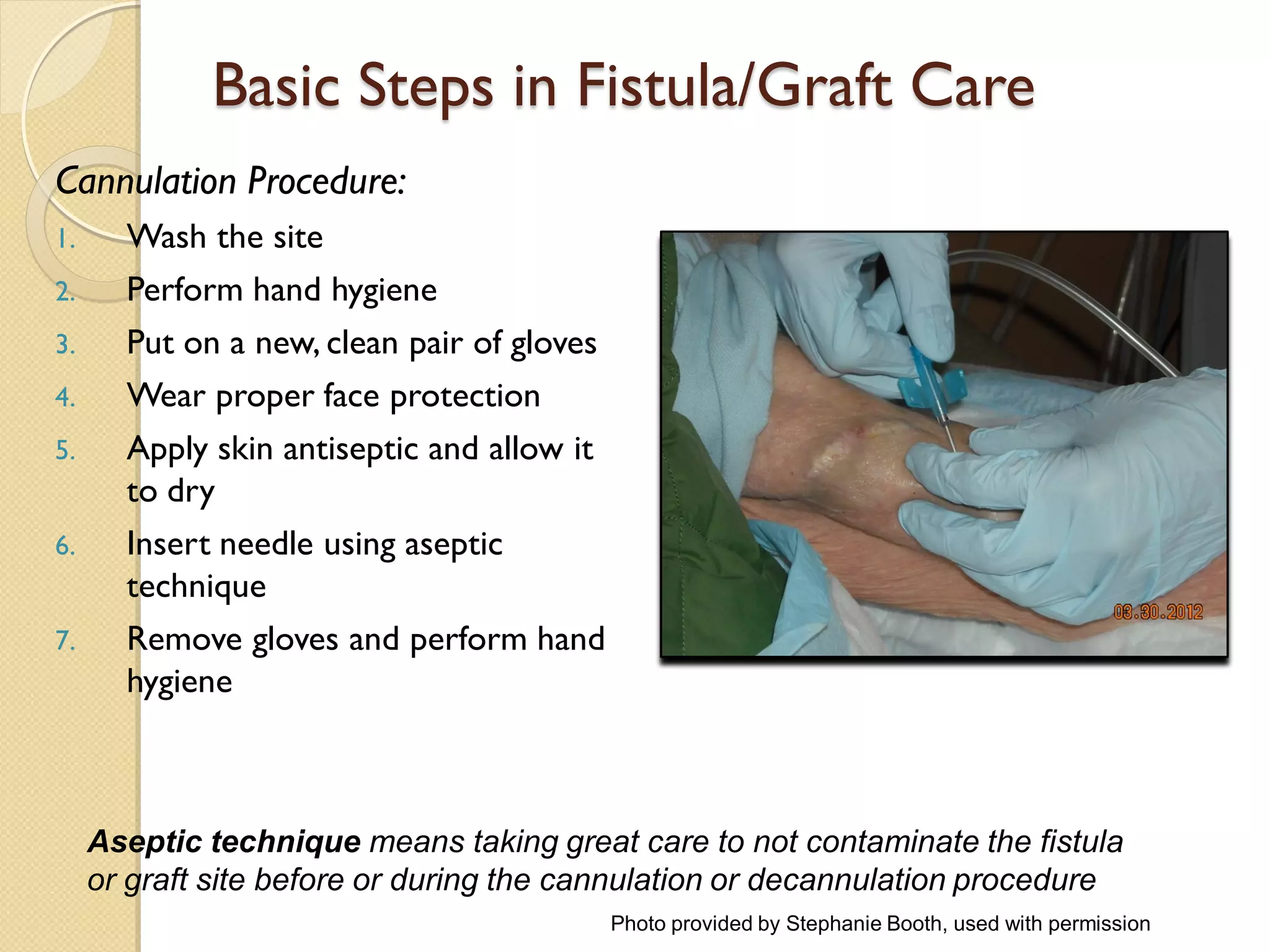 Basic Steps in Fistula/Graft Care
Cannulation Procedure:
1. Wash the site
2. Perform hand hygiene
3. Put on a new, clean pair of gloves
4. Wear proper face protection
5. Apply skin antiseptic and allow it
to dry
6. Insert needle using aseptic
technique
7. Remove gloves and perform hand
hygiene
Aseptic technique means taking great care to not contaminate the fistula
or graft site before or during the cannulation or decannulation procedure
Photo provided by Stephanie Booth, used with permission
 
