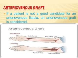ARTERIOVENOUS GRAFT-
 If a patient is not a good candidate for an
arteriovenous fistula, an arteriovenous graft
is considered.
 