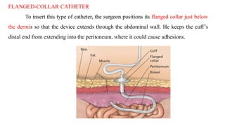 FLANGED-COLLAR CATHETER
To insert this type of catheter, the surgeon positions its flanged collar just below
the dermis so that the device extends through the abdominal wall. He keeps the cuff’s
distal end from extending into the peritoneum, where it could cause adhesions.
 