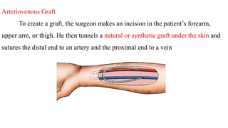 Arteriovenous Graft
To create a graft, the surgeon makes an incision in the patient’s forearm,
upper arm, or thigh. He then tunnels a natural or synthetic graft under the skin and
sutures the distal end to an artery and the proximal end to a vein
 