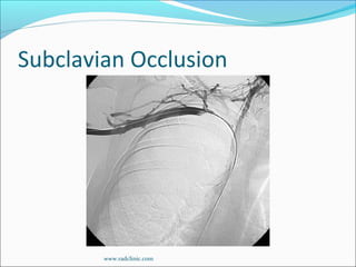 Subclavian Occlusion
www.radclinic.com
 